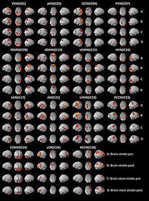 Clinical Effects and Differences in Neural Function Connectivity Revealed by MRI in Subacute Hemispheric and Brainstem Infarction Patients With Dysphagia After Swallowing Therapy